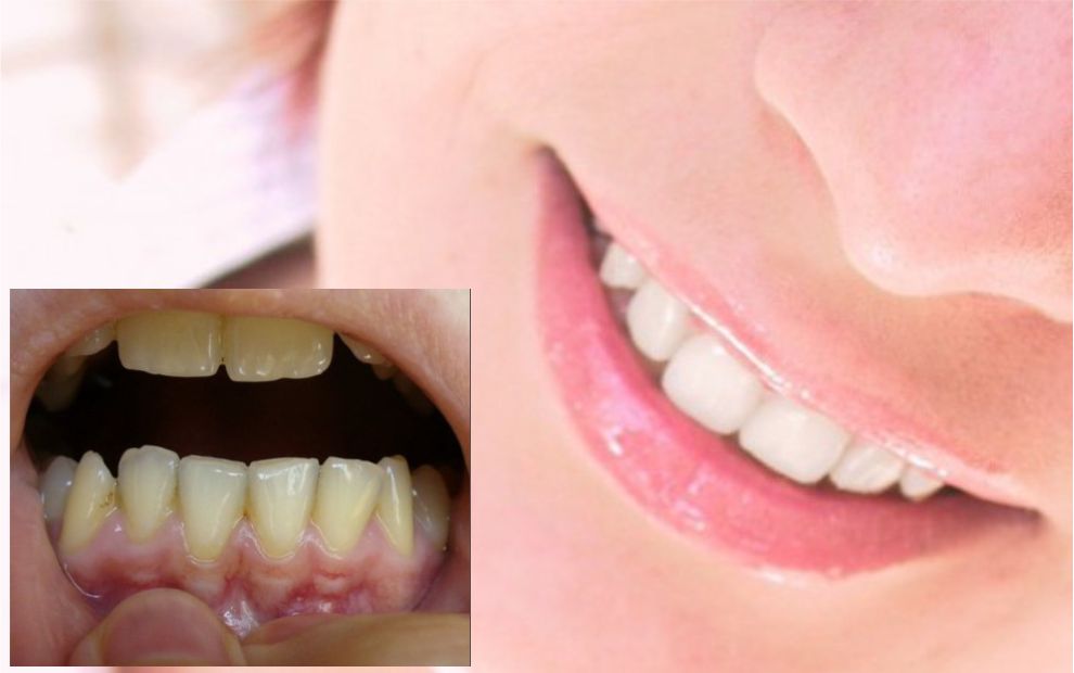 Пародонтозата е заболяване което засяга опорно държащия апарат на зъбите Това