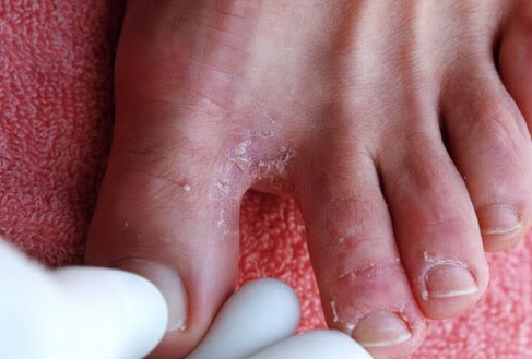 Tinea pedis е вид гъбична инфекция която засяга стъпалата петите