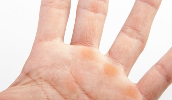 Брадавиците са невъзпалителни възлести образувания на кожата причинявани от вируси