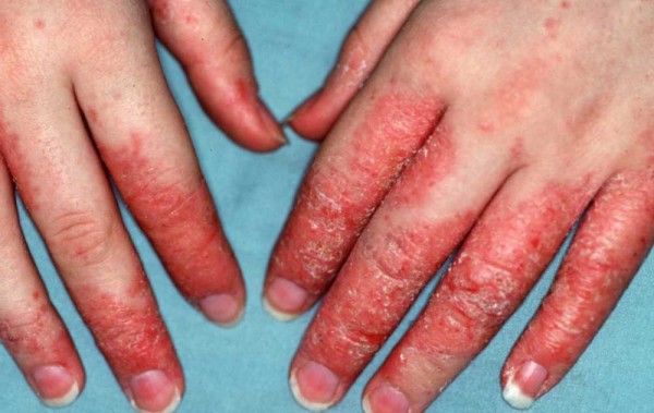 Екзема дерматит е онова неприятно състояние на кожата при което