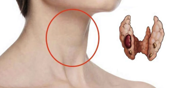 Щитовидната жлеза разположена в областта на шията е жизненоважна за