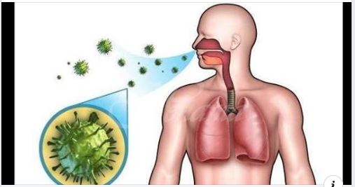Пневмонията е заболяване възпаление на белия дроб и може да бъде