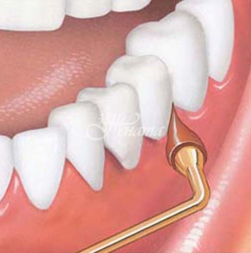 Оголените венци биха могли да доведат до загуба на зъби