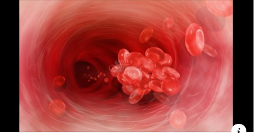 Тромбоза и емболия се появяват когато кръвта не тече добре