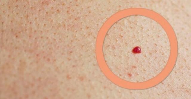 Ако изведнъж сте открили объркваща червена точка на кожата си