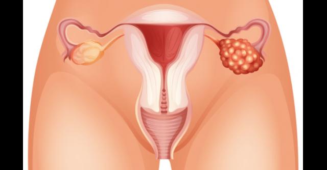 Ракът на яйчниците при жените не е рядка болест, а